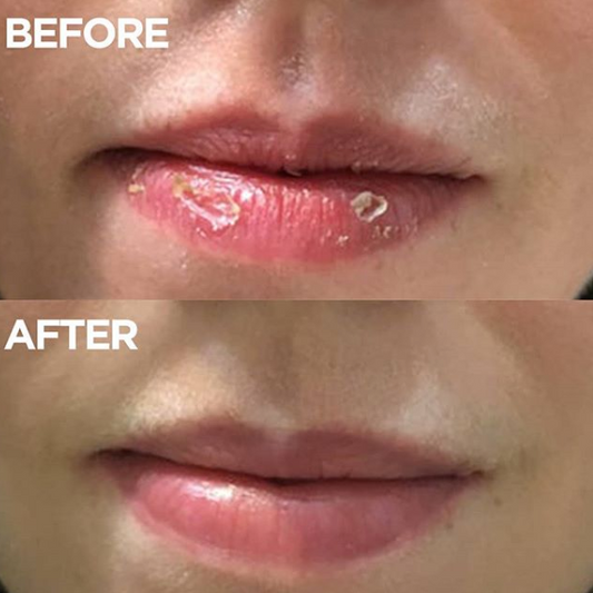 Before and after 101 Ointment