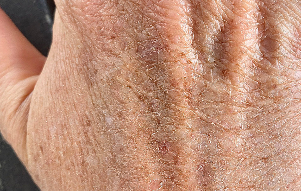 Close up shot of extremely dry, cracked and scaly hands before using Lanolips' Golden Dry Skin Miracle Salve. Formulated with all-natural lanolin, antibacterial Manuka Honey, and antioxidant vitamin E - to hydrate, smooth and nurture skin.