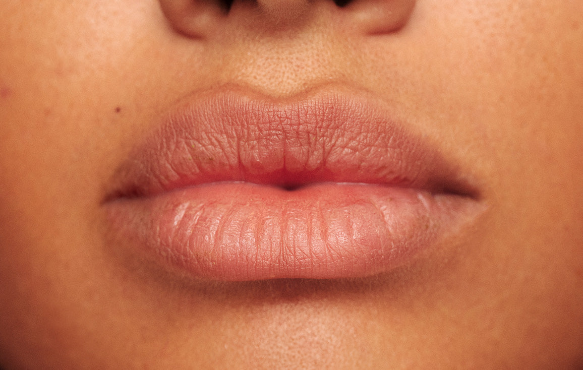 Close up image showing dry, crack lips before using Lanolips Sun Balm SPF 30 Tropical lip balm. From the creators of "The World's Best Lip Balm", comes Lanolips Sun Balm SPF 30 Tropical lip balm - an evolution of the award-winning 2009 classic. Made for all-year round sun protection. It's the sun, in a tube.