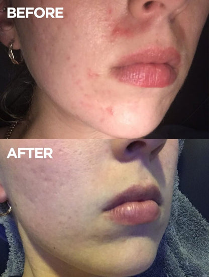 Before and after images showing visible improvement in skin texture and hydration after using Lanolips Face Base Day Cream with Lanolin and Vitamin E – redness and dryness reduced, skin appears smoother and more nourished.
